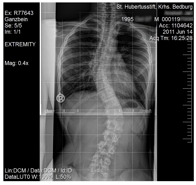 Scoliosis Subject